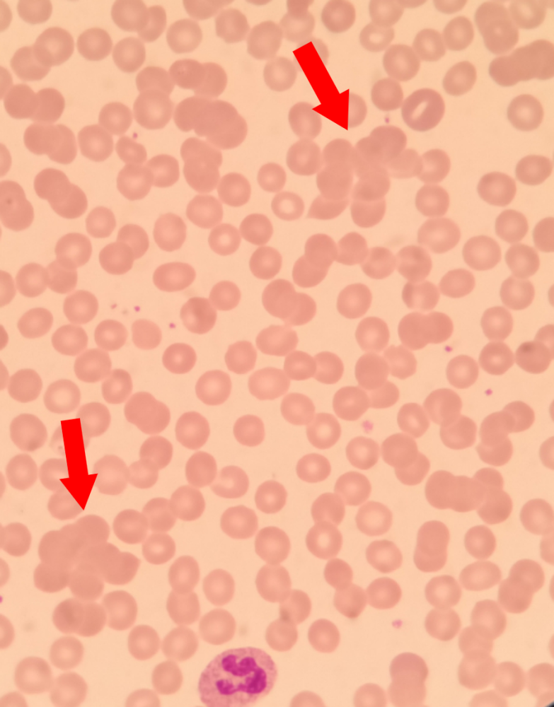 等待温育解聚的时间里,血涂片干燥镜检,镜下可见红细胞聚集成团或缗钱