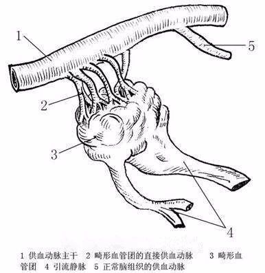 帶您認識腦動靜脈畸形|腦動靜脈畸形|動脈|血管|動靜脈畸形