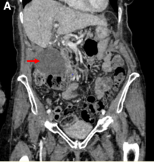 患者墨菲氏征阳性,是急性胆囊炎吗?|病例学习_腾讯新闻