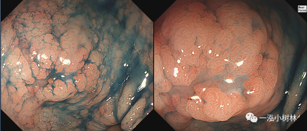 正常胃与十二指肠黏膜结构