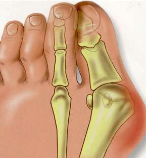 跑步后前脚掌疼痛你应该看看这个