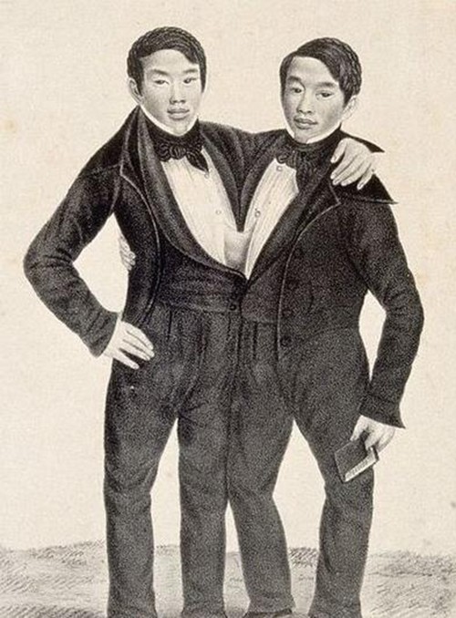 和别的婴儿不同的是,这两兄弟是一对连体婴,本来清朝时期就很少出现
