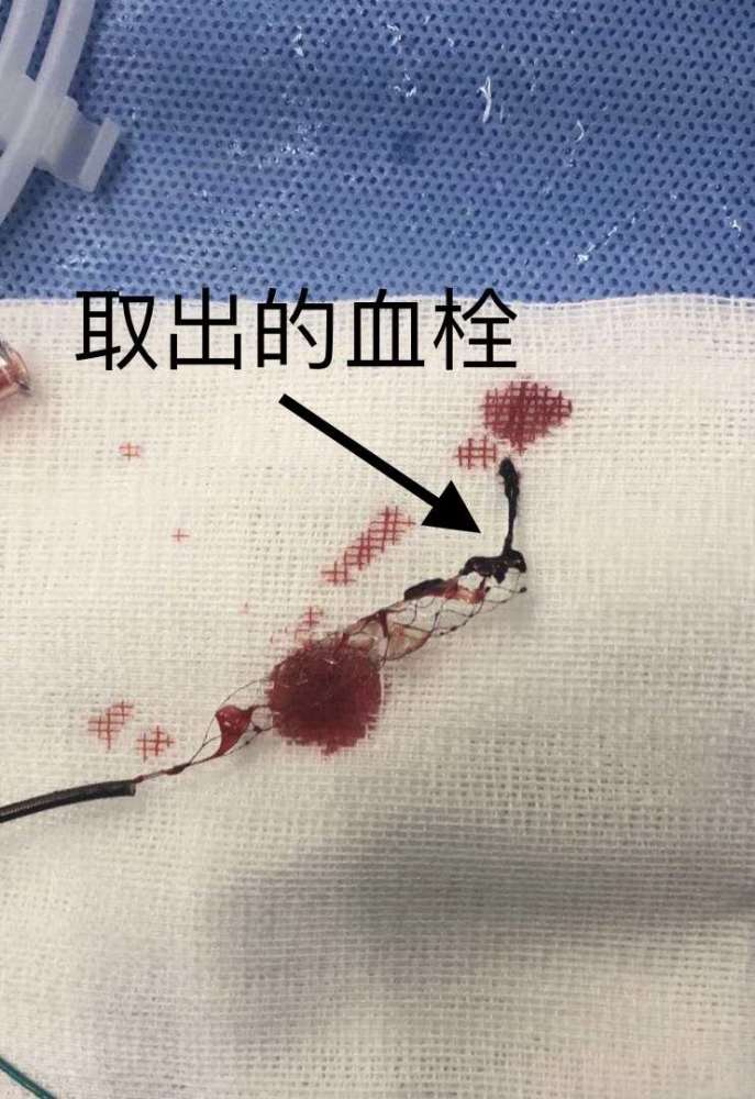 直接机械取栓介入治疗!