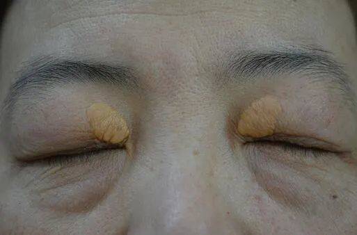 这类人群易诱发眼癌做好这一点对抵抗肿瘤很重要