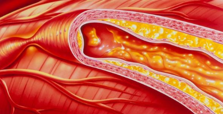 心脏堵塞会危及生命!心血管专家告诉您:这样判断心脏堵没堵