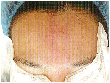 【微整形注射并发症】栓塞的临床表现及鉴别与诊断!