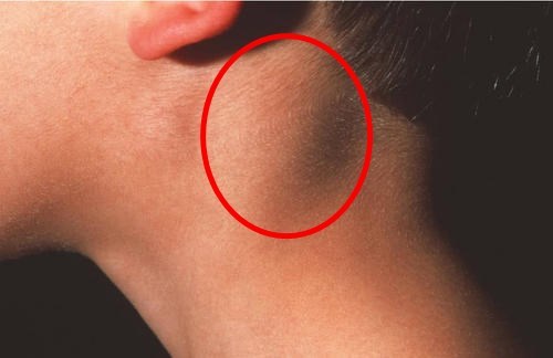淋巴结肿大不消当心是结核菌感染这么做可辨别