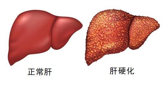 正常肝与肝硬化对比模式图