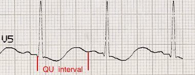 一文彙總6種qtqtc間期延長的心電圖
