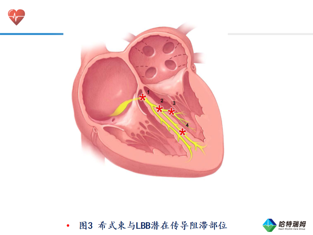 【研讨现场实录】左束支传导阻滞:现状与未来展望