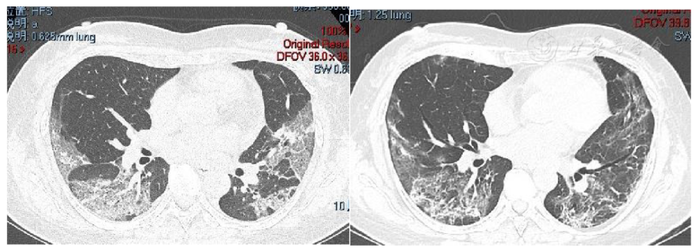 新型冠状病毒肺炎炎症后肺纤维化的现状与思考_腾讯新闻