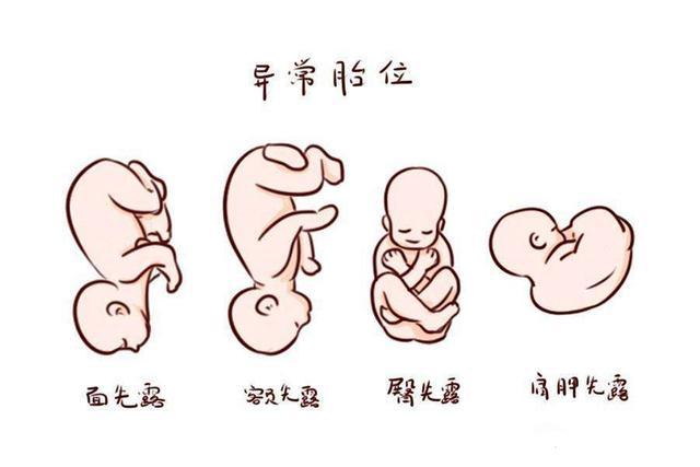 临近预产期胎儿不入盆,会是什么原因?三种运动可助力