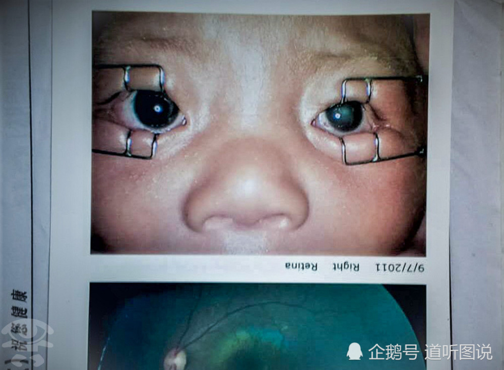 西西的父母赶紧带他到西安的西京医院,经检查确诊为先天性白内障