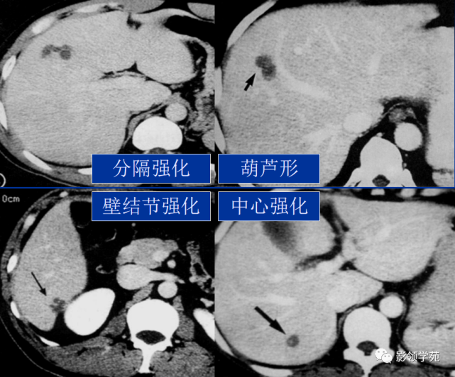 肝炎性假瘤影像學表現