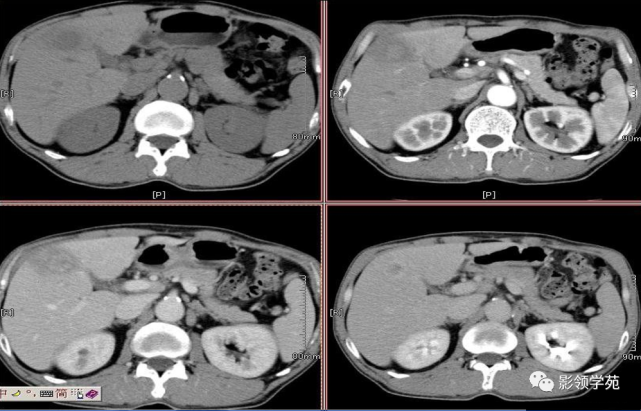 肝炎性假瘤:肝脏s6段可