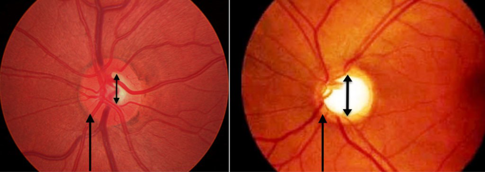眼底一张照眼病早知道关注眼部健康你要知道这些