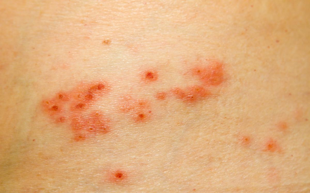 儿童时期发生的水痘,皮肤组织中的水痘-带状疱疹病毒会沿神经系统轴突