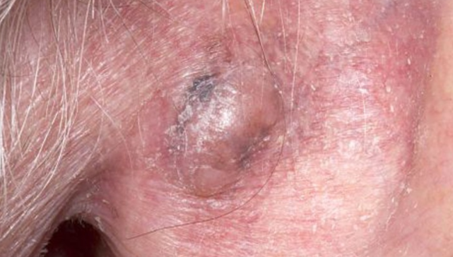 狗不断舔舐其耳朵后面的病变后去看医生,从而确诊恶性黑色素瘤的经历