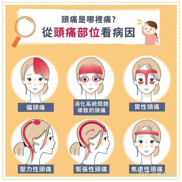 偏头痛,窦性头痛……头痛也分类,你找对原因了吗?_腾讯新闻