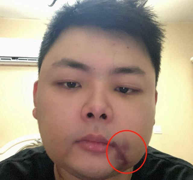 照片中的西卡,虽然已经拆掉了线,但还是能够看出不少伤痕.