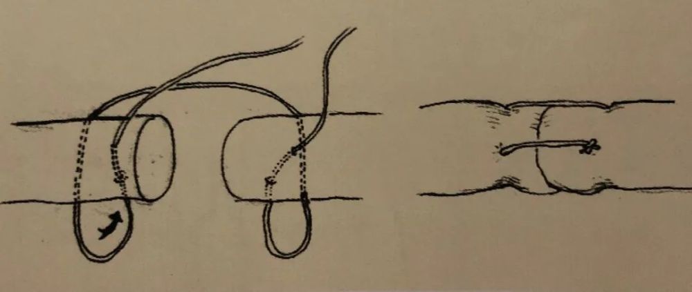 【骨科小技巧】骨科手术的双"十"字缝合小技巧!_腾讯新闻