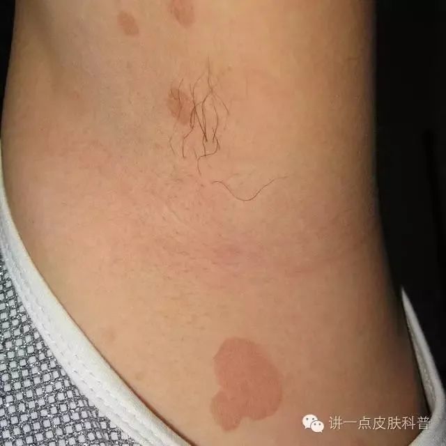 一到夏天前胸后背腋窝出现褐色圆形斑是啥会不会传染