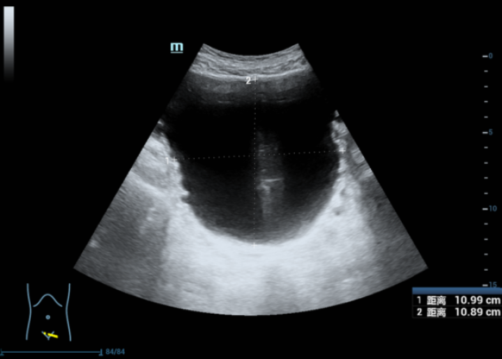您的情况和片子上膀胱彩超图来看,应该就是前列腺增生引起的尿潴留
