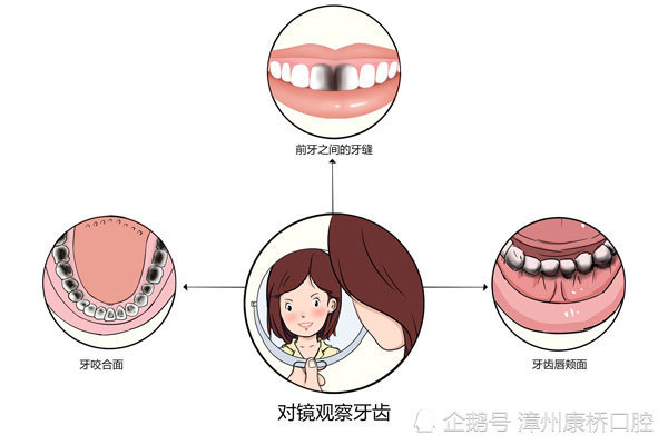 2,牙齿形态和质地的改变:发生龋坏的牙齿硬组织会脱钙,变软,表面会
