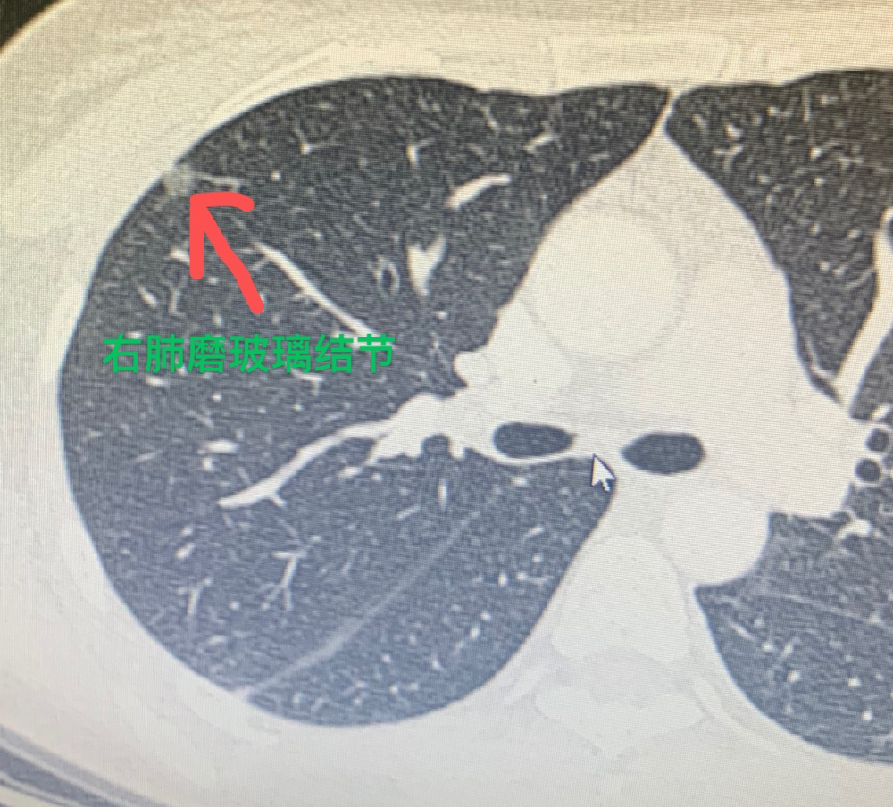 35岁年轻女性一年内就能发展成局部晚期癌症 她忘做了这件事 腾讯新闻