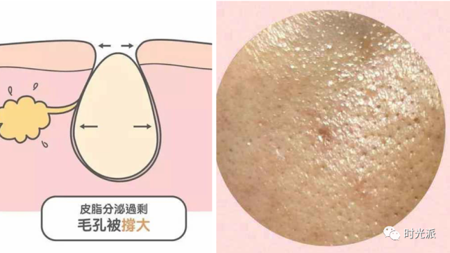 皮脂腺分泌旺盛 腾讯网