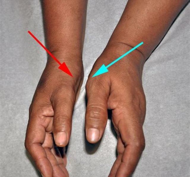 管状的结构,这个结构里装的9根肌腱和一根神经,这根神经叫做正中神经