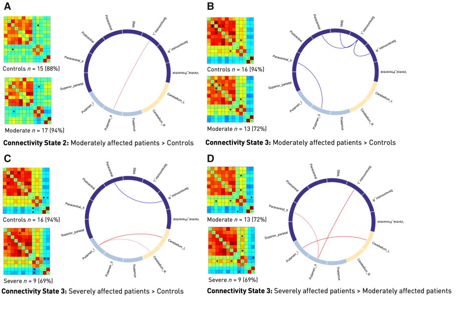 急性缺血性脑卒中|Brain：急性缺血性脑卒中大脑运动网络的瞬态变化