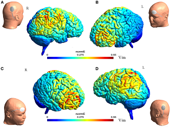 brain stimulation|Brain Stimulation：经颅直流电刺激有效治疗难治性癫痫