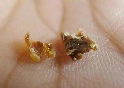 男孩掏耳朵引发癫痫千万别乱掏耳朵耳屎的这些好处你不知道