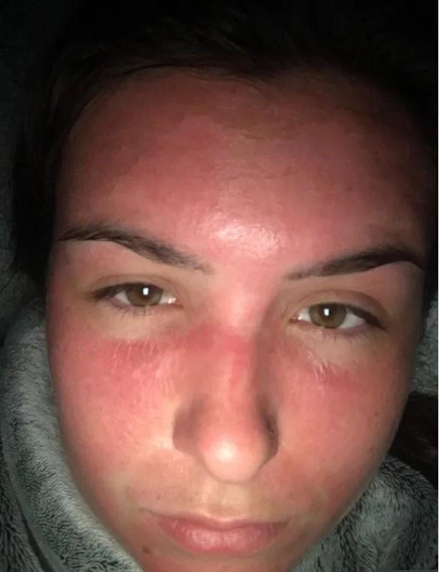 太阳中毒英国女子在海滩晒6小时整张脸肿起来