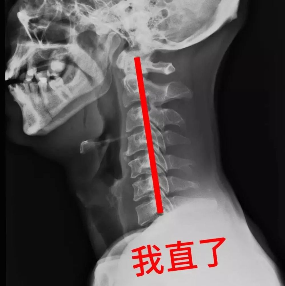 睡觉手麻,偶尔头晕,干呕……你的颈椎还好吗?