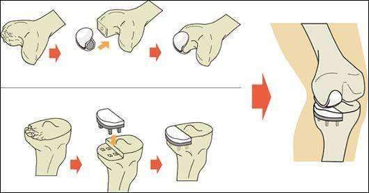 人工膝关节置换的长期效果如何 膝关节置换费用是多少 腾讯新闻