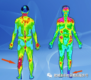 红外热成像就是通过仪器接受人体的热辐射线,通过分析成像来判断疾 病