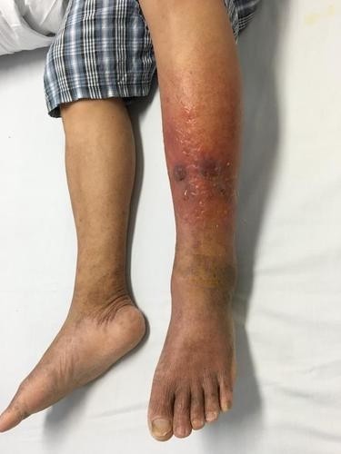 小心皮肤病找上门 珠海一男子雨后趟水患上丹毒 皮肤病 足癣