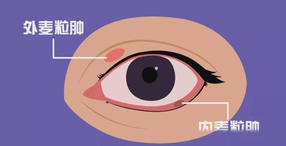 耳穴治疗麦粒肿,效果显著!