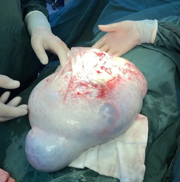 17岁少女肚子逐渐隆起 医院检查吓一跳