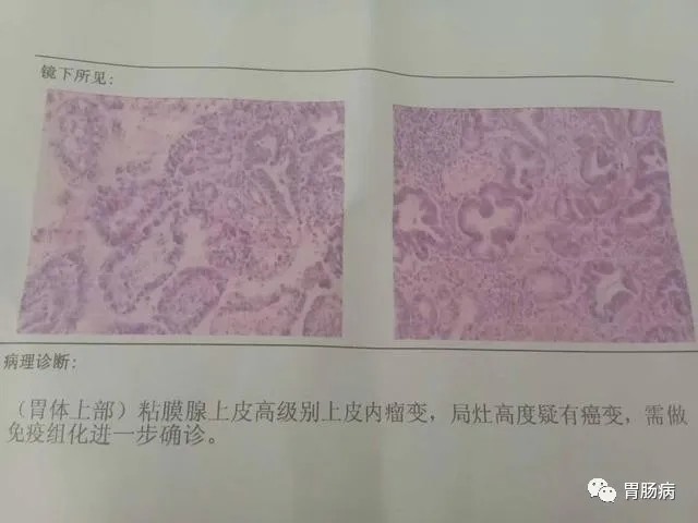 3月24日,病理结果出来:高级别上皮内瘤变(原位癌),不排除黏膜内癌.