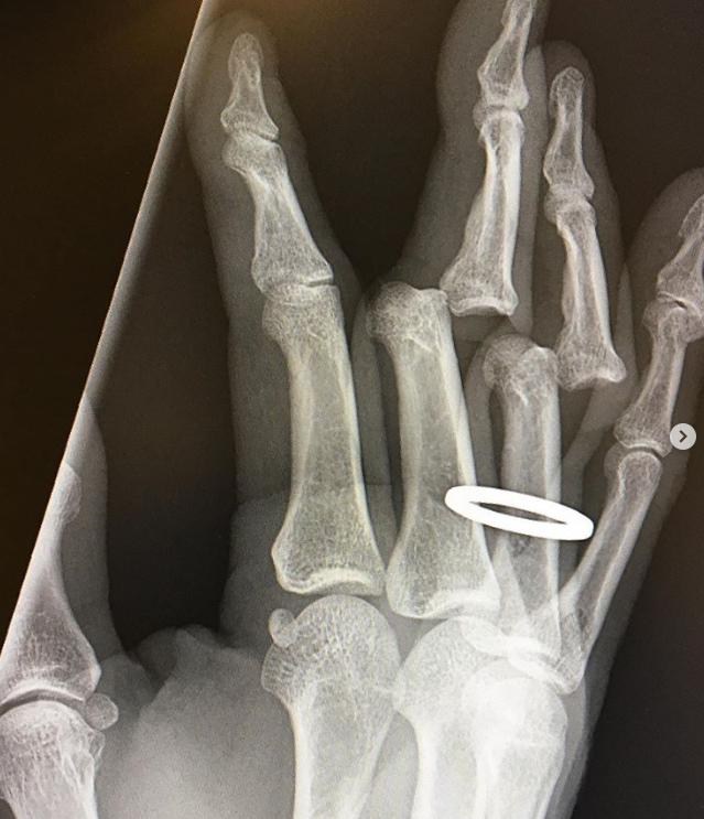 男星因事故致手指骨折,受伤照曝光:手指关节彻底移位