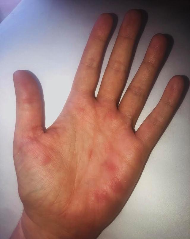 萨拉患病时英国大约只有12例新冠肺炎病例,那时英国人对新冠病毒还不
