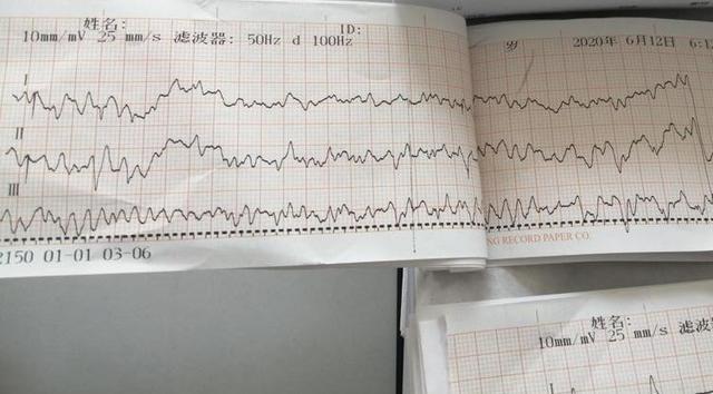 事发当时心电图显示患者室颤这时闻讯赶来的患者的老伴到达了现场