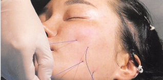 惊大v线在皮肤内断了线雕从脸上游离到下巴闹心