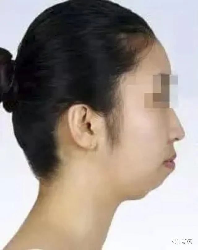 1,下颌骨发育不良下颌线不清晰的类型和解决办法而前阵子周扬青在雪梨