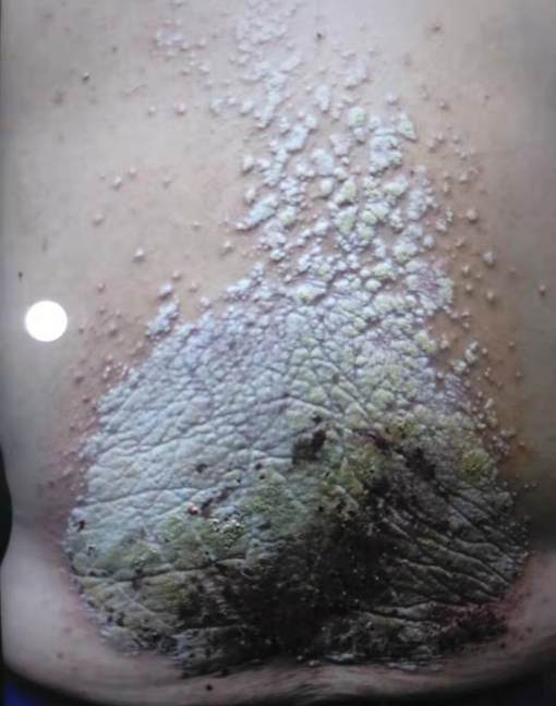 如何做到"纵有诸样症,一针合谷效通神"?