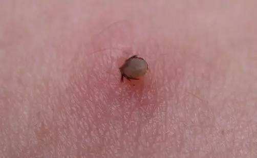 人被蜱虫叮咬后会危及生命为什么