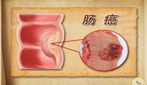 大肠癌前期的6个症状,超过3个以上,你需要去医院了